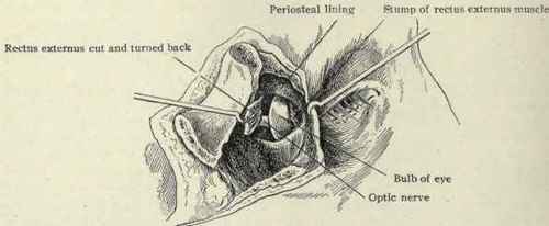 Fig.92. The edges of the incised periosteum have been separated and the external rectus muscle divided, exposing the space posterior to the bulb. (Kronlein's operation for obtaining access to the retrobulbar region).