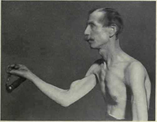 Pig. 281.   Rupture of the tendon of the long head of the biceps muscle, producing a swelling comparatively low down.