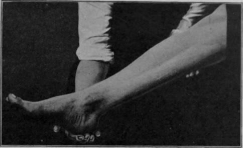 Fig. 1. To show contour of the muscles, the lower limb being at rest and supported. Note that the long axis of the oval formed is transverse