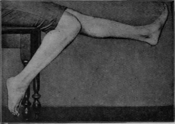 Fig. 104. The final swinging exercise while sitting. Note the plantar flexion of the ankle with flexion of the knee, and dorsi flexion with extension of the knee