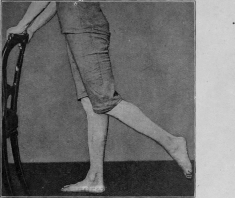 Fig. 105. Swinging the leg while standing. Note plantar flexion of the ankle and flexion of the knee. The patient is shown supporting himself by a chair placed in front of him for clearness in reproduction