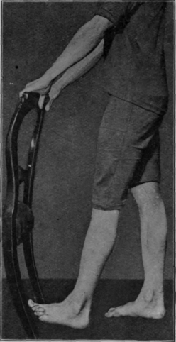 Fig. 106. Second stage in swinging the knee. Note dorsi flexion with extension of the knee
