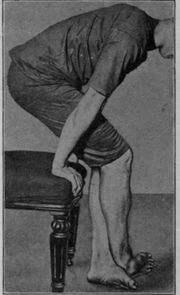 Fig. 113. The third sitting exercise in the re education of walking. Continuation of the clawing exercise. Note the body weight is still partly supported by the arms