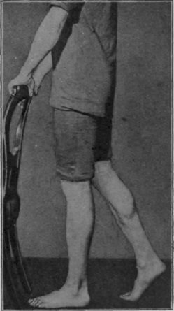 Fig. 116. The second stage in taking a step. The patient then returns to the position shown in Fig. 115, and learns to rock to and fro