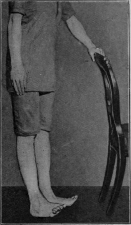 Fig. 121. To illustrate the exercise in which the patient stands on the heels. Note that the inner borders of the feet are raised more than the outer