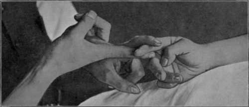 Fig. 144. To show the grip for rolling the flesh of a digit to loosen the tissues when a nerve has been caught in the scar