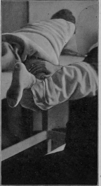 Fig. 145.   To show position for treatment of a case of sciatica, the cure being well advanced