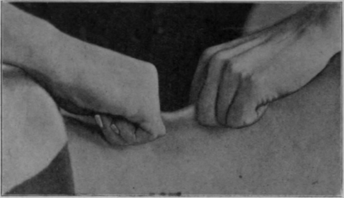 Fig. 148.   To show dry cupping of the back by massage