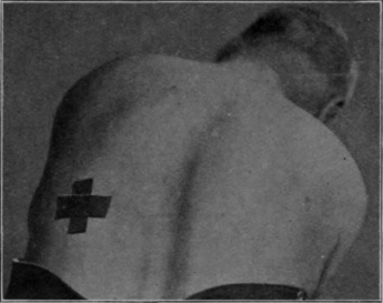 Fig. 150. To illustrate the position for a special breathing exercise when the patient has suffered from a left sided empyema. The hand of the masseur is placed over the area marked by the cross, and the patient endeavours to push the hand away during inspiration