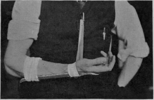 Fig. 158. To show how a forearm may be slung in supination while a short metal splint is still worn