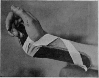 Fig. 161. A short cock up splint applied so as to exert as little obstruction as possible to the return of the blood in the veins on the back of the hand