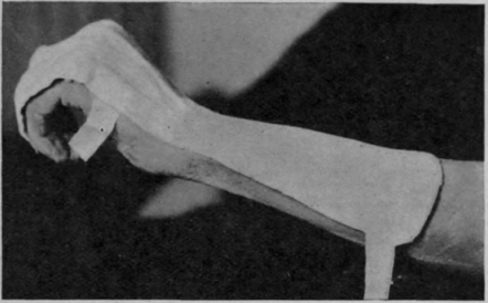 Fig. 163. A posterior plaster splint which inhibits over action of all the extensors while allowing perfect freedom of action to the flexors of the fingers