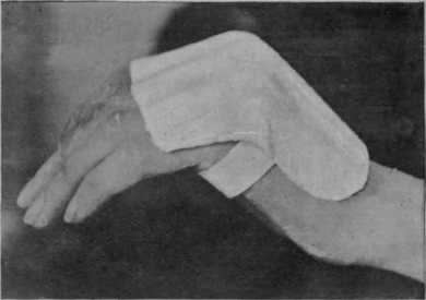 Fig. 164. A posterior plaster splint which only inhibits over action of the extensors of the metacarpo phalangeal joints. There is a tendency for this splint to rest the interossei as well. In practice, when these muscles are paralysed, the interphalangeal joints remain extended when the proximal joints are flexed and the long flexors are also at rest. The latter are, of course, free to act; but, on relaxing, the fingers tend to straighten when this splint is applied. If, on the other hand, the interossei are paralysed and the metacarpo phalangeal joints are free to extend, flexion deformity at the interphalangeal joints is inevitable