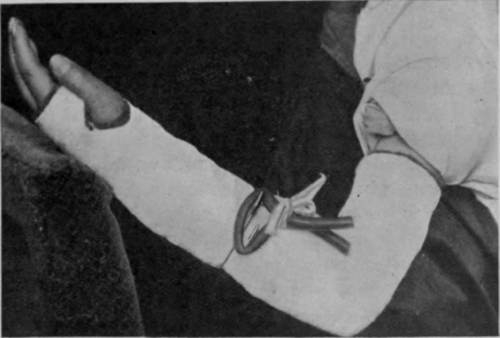Fig. 166. Capt. Verrall's supinating (or pronating) plaster of Paris splint