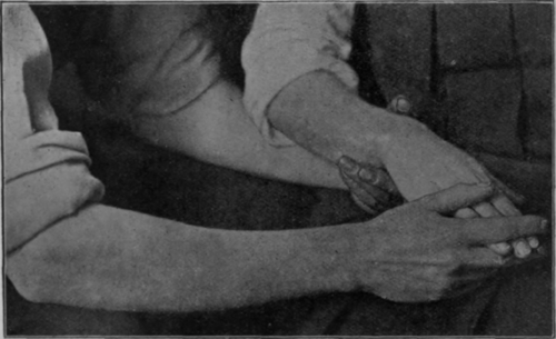Fig. 17. To show extension of fingers with flexion of the wrist