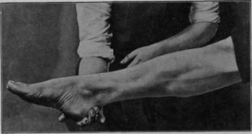 Fig. 3. Contour with muscles contracted, the limb being supported only at the heel. The contour is more nearly circular than in Figs. 1 or 2