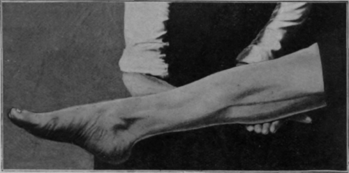 Fig. 4. Contour with limb in same position as in Fig. 3, but with the calf supported. Note that the pressure on the calf now causes little or no change in the general outline of the limb, as the muscles are contracted