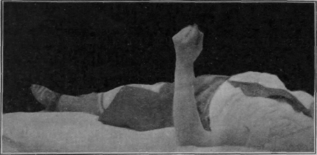 Fig. 41. To show the position for free rotation of the forearm, the patient being recumbent