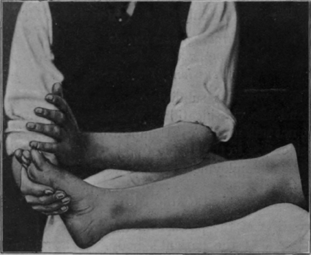Fig. 5. Showing upward surface stroking of the lower extremity. In practice, in order to secure the fullest effect, the stroke should be continued up the thigh. Note that the stroke commences before the hand comes in contact with the limb, and also the slight flexion of the knee