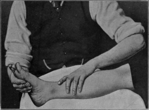 Fig. 6. Showing upward surface stroking of the lower extremity, the middle of the stroke. Note how the hand is adapting itself to the contour of the limb. There is no fear of the patient noticing any scratching or tickling sensation