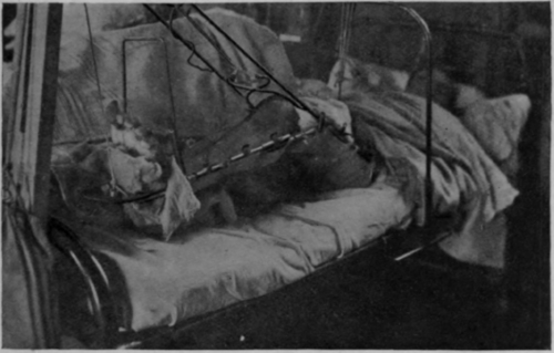 Fig. 88. To show the application of a common form of calliper extension as applied to a fractured femur. Note that full extension of the knee is impossible, as the top of the shin meets the cross of the calliper before this position is reached