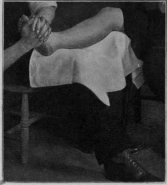 Fig. 90. To show a useful grip for mobilisation of the tarsal and tarso metatarsal joints. Kneading the foot without allowing the hands to slip over the surface of the skin may be performed in the same position