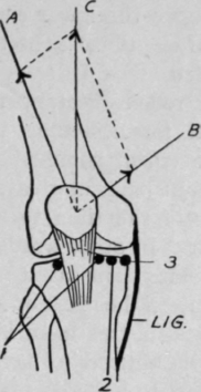Fig. 91. (After Robert Jones.) To show how wasting of the vastus internus alters the resultant of the direction of the pull of the whole quadriceps, thus causing the movement of the patella to deviate from its normal direction
