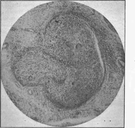 A group of tubercles with giant cells In tuberculosis of the synovial membrane, x 00.
