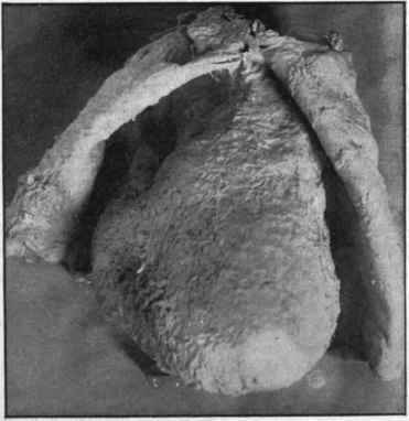 Acute pericarditis. The surface of both visceral and parietal layers of the pericardium is coated with fibrine.
