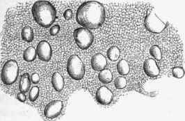 Amyloid bodies from cord, x 300.