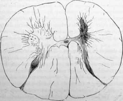 Anterior poliomyelitis.