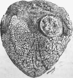 Cancer occurring in a tongue the seat of leucoplakia.