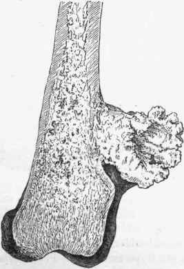 Cartilaginous spongy exostosis of femur.