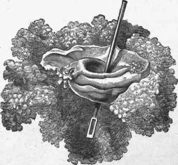 Cauliflower cancer of posterior lip of os uteri.