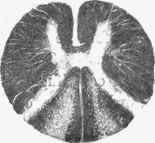 Cord in early stage of locomotor ataxia.