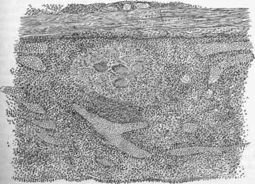 Dura mater with organized clot coating its internal surface.
