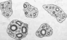 Fatty infiltration of liver.