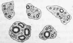 Fatty infiltration of the liver as seen in the fresh state.