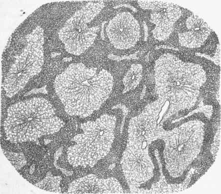 Fatty infiltration of the liver; oamic acid preparation as seen with a very low power.