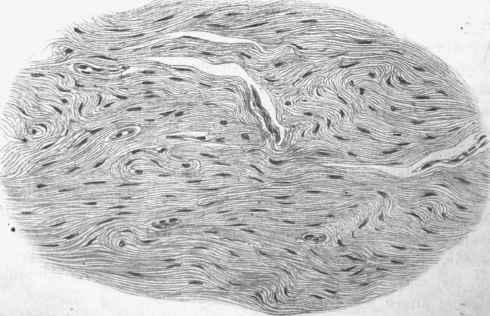 Fibroma originating in connection with fascia.