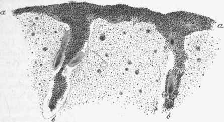 From a case of cerebro spinal meningitis, a, a, The soft membranes infiltrated with pus, also passing into the sulci, b, b.