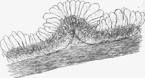 From internal surface of a colloid ovarian cyst.
