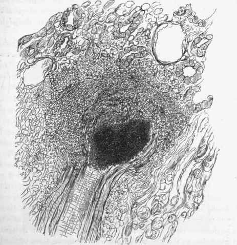 From the kidney in ulcerative endocarditis.