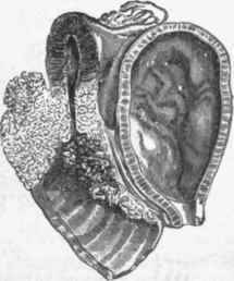 Ginccr of uterus, the parts shown in section.