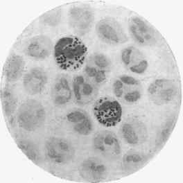 Gonococcus. Two pus corpuscles are seen whose protoplasm is filled with diplococci.