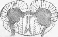 Hydromyelia. Enlarge ment of central canal backwards.