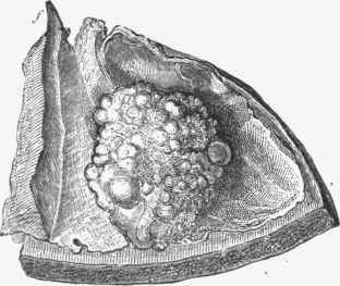 Internal ivory exostosis of the frontal bone.