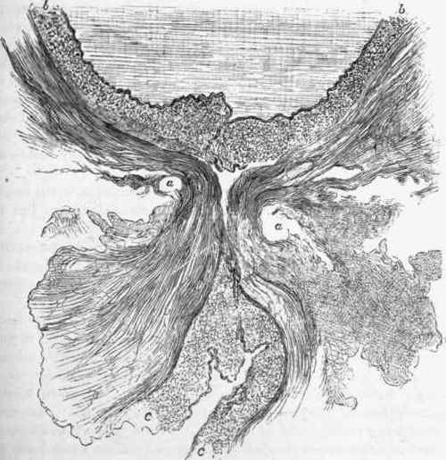 Longitudinal section of an artery at seat of ligature, u, a, apertures in which the silk ligature was found.