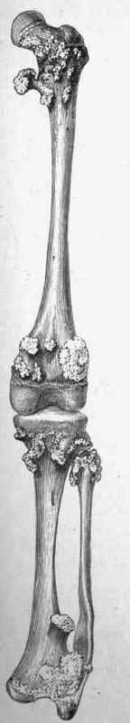 Multiple exostoses of femur, tibia, and fibula.