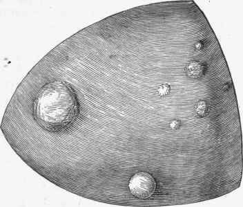 Multiple exostoses of the frontal bone.